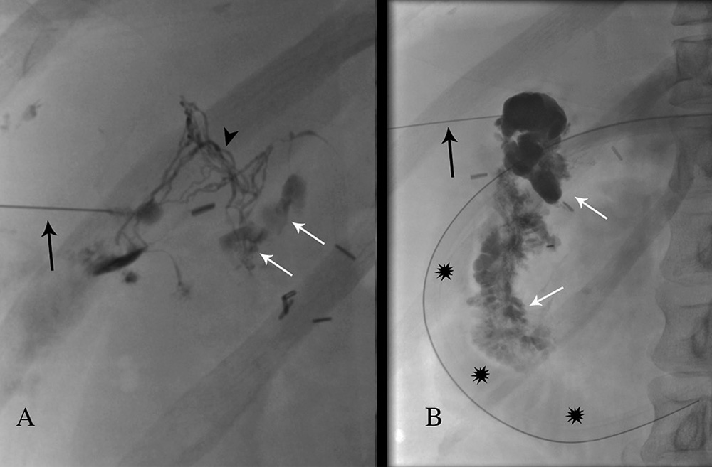 Injection of the contrast into subhepatic mass